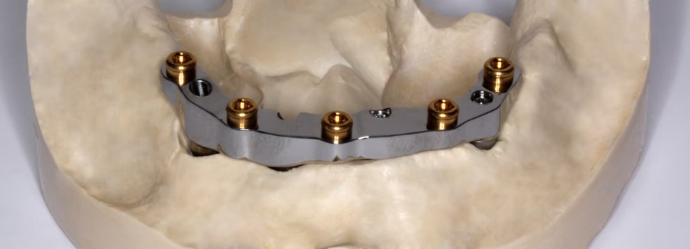 All-on-X full-arch case photograph 1 of 5