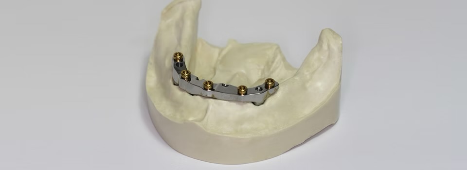 All-on-X full-arch case photograph 3 of 5